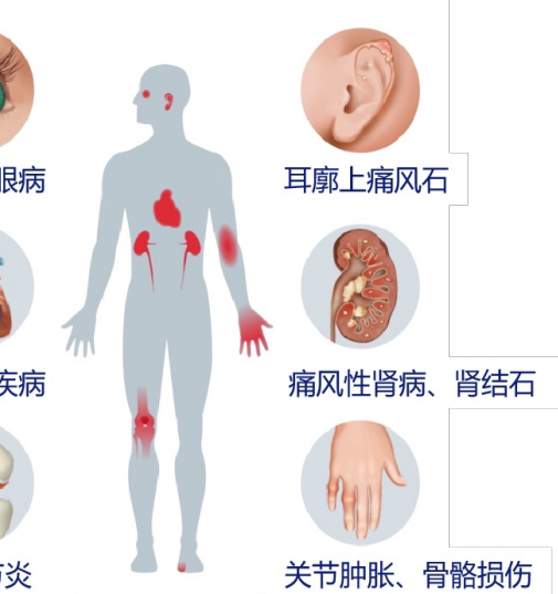 痛风不同阶段,如何选择最有效的治疗方案? 痛风不同阶段,如何选择最有效的治疗方案?